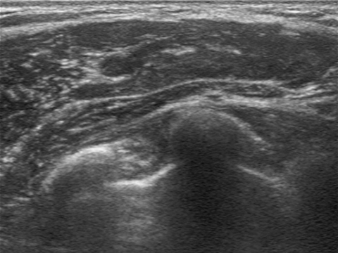 Breast Revision Surgery