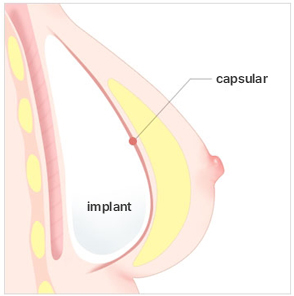 Breast Revision Surgery