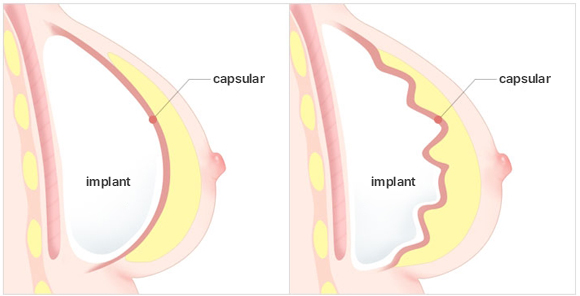 Breast Revision Surgery