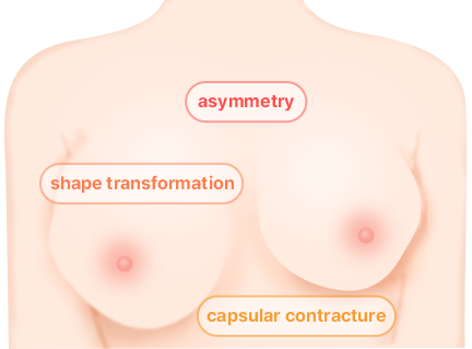 Breast Revision Surgery