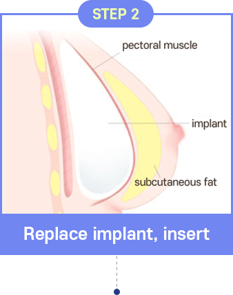 Breast Reconstruction