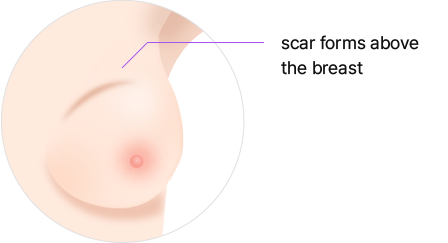 Breast Reconstruction