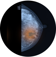 Breast Cancer