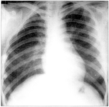 Poland Syndrome Correction