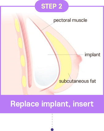 Poland Syndrome Correction